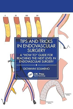 Tips and Tricks in Endovascular Surgery: A “How to” Guide for reaching the next Level in Endovascular Surgery 1st Edition